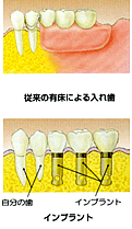 従来の有床による入れ歯とインプラント
