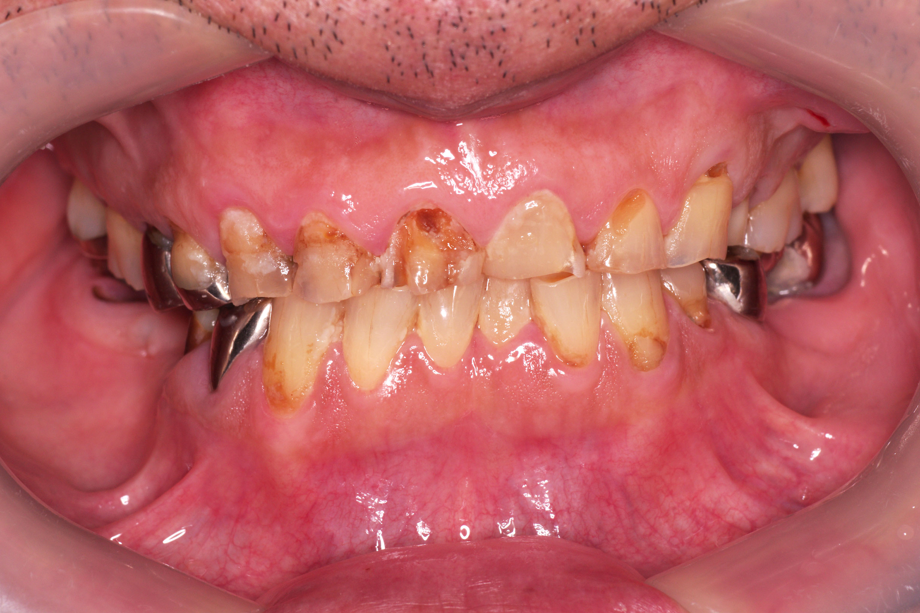 歯周外科術前
